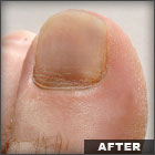 About Toenail Fungus, cures,