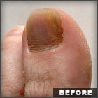 About Toenail Fungus, cures,