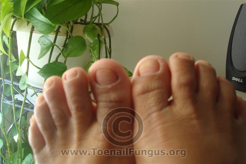 does lamisil cream treat toenail fungus