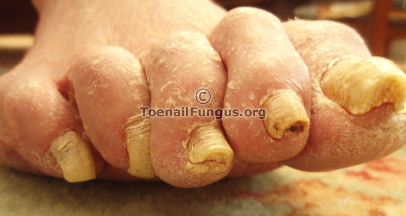 What are the most common types of nail fungus?