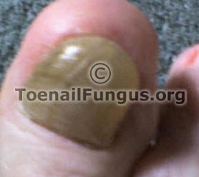 Big Toenail Pain