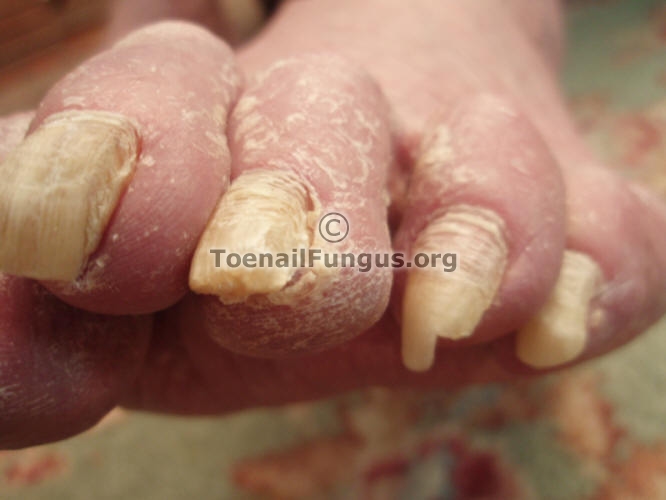 Toenail Fungus - Symptoms, Pictures, Treatment, Home ...