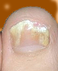 White Toe Fungus