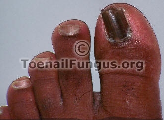 How do you get rid of black toenails?