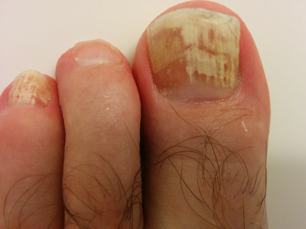 Toe Fungus Issues