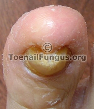 big toe, nail fungus - click for larger image