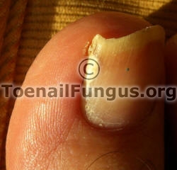 fungus on one side of big toe.