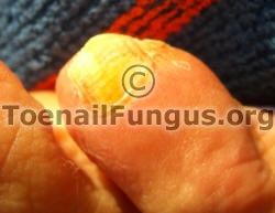 Little toe fungus. click to enlarge.